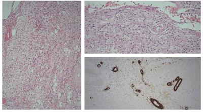 Case report of iatrogenic cerebral amyloid angiopathy after exposure to Lyodura: an Australian perspective